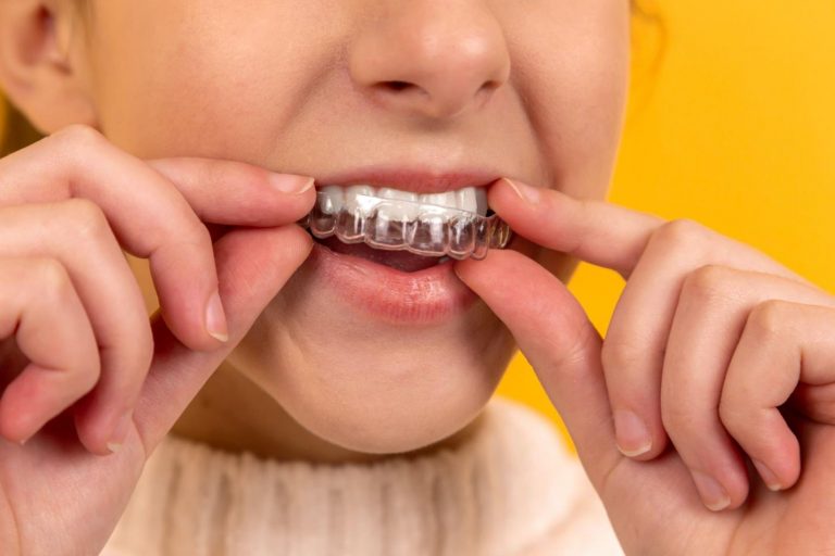 Invisalign Versus Braces: Which Is Perfect for You?
